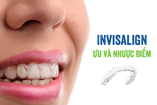 Niềng răng Invisalign là gì? Có hiệu quả, an toàn hơn không?