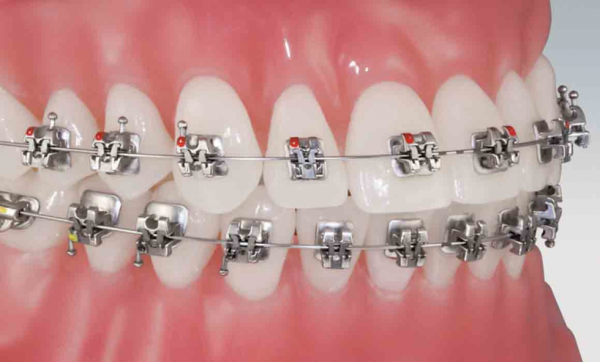 Niềng răng mắc cài sắt: Giải pháp hiệu quả cho nụ cười hoàn hảo