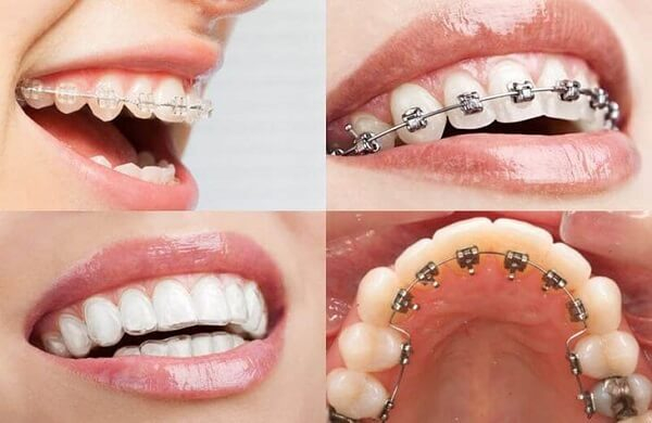 Giai đoạn xấu nhất khi niềng răng: Bí quyết giữ nụ cười hoàn hảo