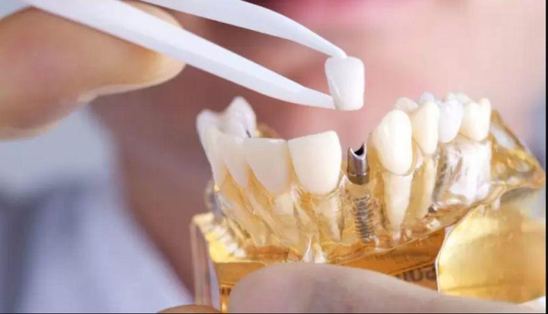 Vị trí và số lượng răng bị mất là yếu tố quan trọng ảnh hưởng đến quá trình lấy dấu implant.