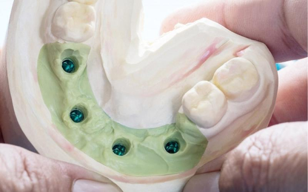 Lấy dấu implant là quá trình lấy lại chi tiết hình thái vùng hàm bị mất răng để chế tạo bộ phận thay thế cho răng bị mất