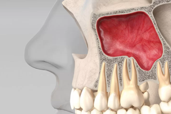 Nguyên nhân dẫn đến xoang hàm bị hở là đo sâu răng, viêm tủy không điều trị kịp thời