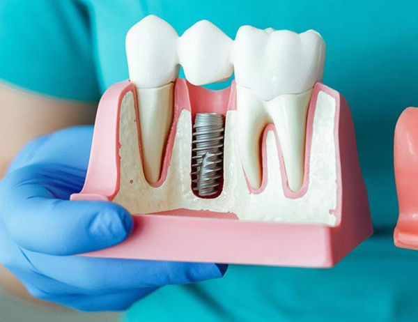 Vít kết nối răng Implant bị lỏng hoặc gãy
