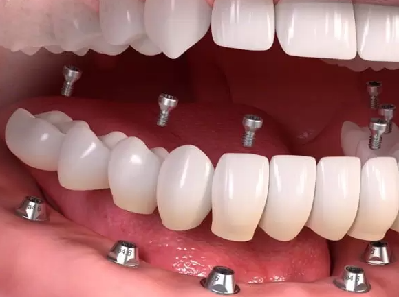 Nguyên nhân khiến răng Implant bị lung lay thường gặp là gì?