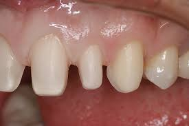 Những trường hợp nào cần làm răng mài bọc sứ?
