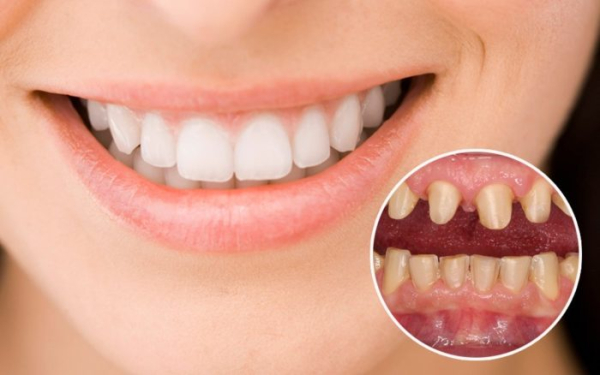 Mài răng bọc sứ là gì? Có ảnh hưởng gì không?