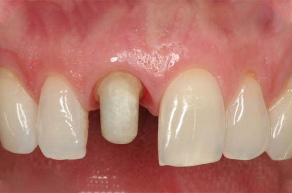 Nếu được thực hiện đúng quy trình chuẩn và kỹ thuật chính xác, quá trình mài răng sẽ không để lại bất cứ biến chứng nào