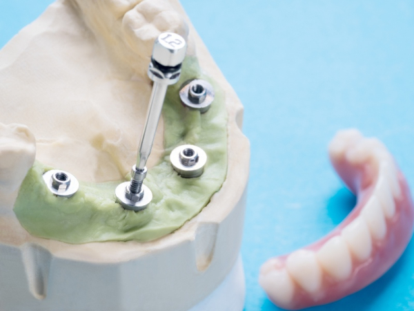 Sau khi ghép mini implant tuyệt đối không được nhai hoặc nghiến răng mạnh trong 3-6 tháng đầu để tránh lỏng implant