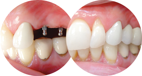 Nhờ kích thước siêu nhỏ nên mini implant được chỉ định để ghép 1-2 răng thiếu ở những vị trí xương hàm bị giới hạn