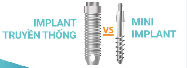 Mini implant và implant thông thường có nhiều điểm khác biệt rõ rệt