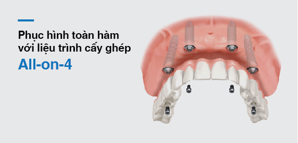 Phương pháp trồng răng implant all on 4 mang lại nhiều ưu điểm vượt trội cho người bệnh