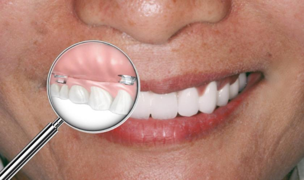 Trường hợp nào nên áp dụng trồng răng implant all on 4?