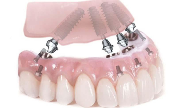 Trồng răng implant all on 4 - Ưu và nhược điểm