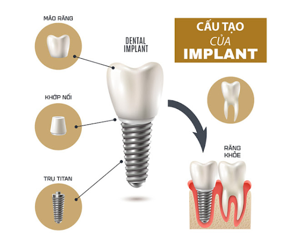 Trồng răng implant là gì? Những điều cần biết trước khi thực hiện
