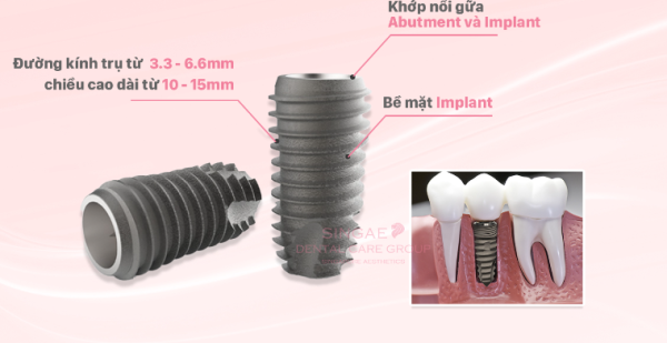 Trụ implant DIO được cấu tạo từ hai vật liệu chính là titanium và abutment