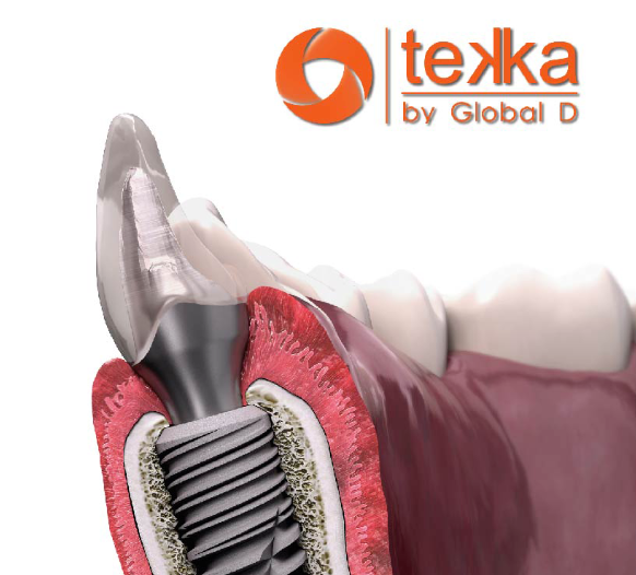 Trụ Implant Tekka có nhiều ưu điểm vượt trội