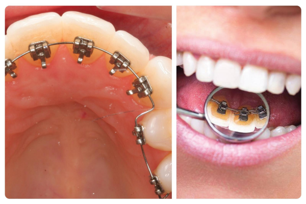 Niềng răng mặt trong là một phương pháp điều trị răng miệng hiệu quả