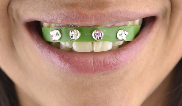 Niềng răng tại nhà: Cách hiệu quả và những khuyết điểm