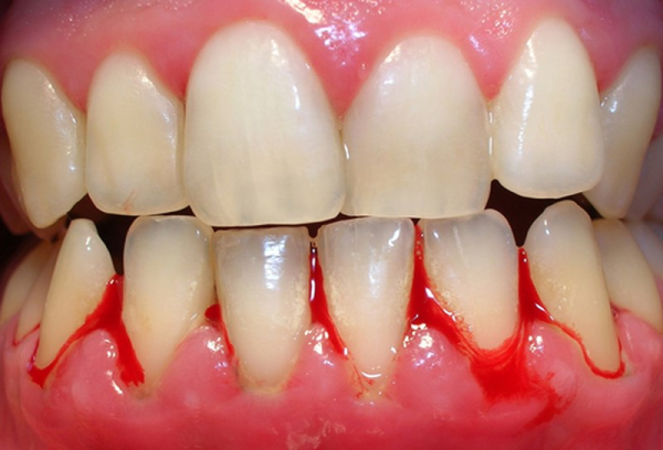 Áp lực sai cỡ hoặc cách niềng không đúng có thể làm tổn thương răng và nướu