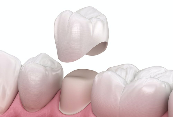 Bọc răng sứ giúp khắc phục tình trạng răng hô