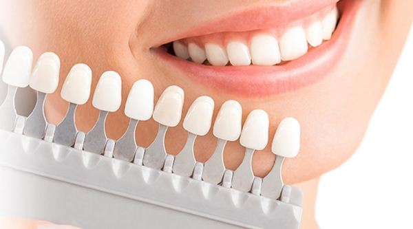 Phương pháp dán răng sứ Veneer