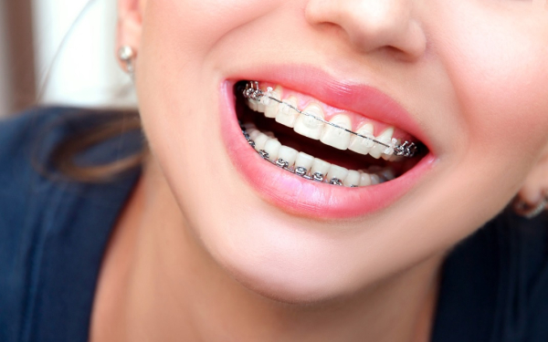 Niềng răng giúp hàm răng đều đặn và đẹp hơn