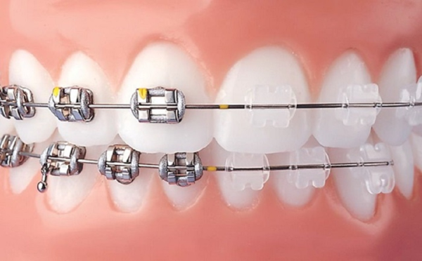 Niềng răng mắc cài kim loại: Hiệu quả và chi phí cần biết