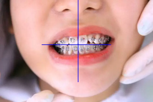 Đối diện với niềng răng không hiệu quả: Làm thế nào để sửa chữa?
