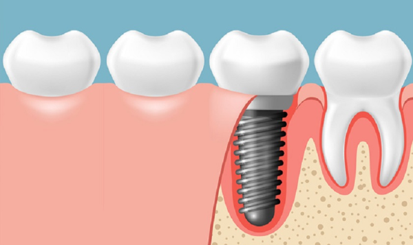 Trồng răng implant có đau không? Sự thật về quá trình điều trị