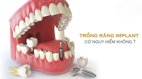 Trông răng implant có nguy hiểm không?