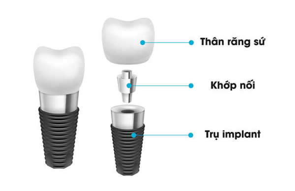 Cấu tạo răng implant gồm những gì?