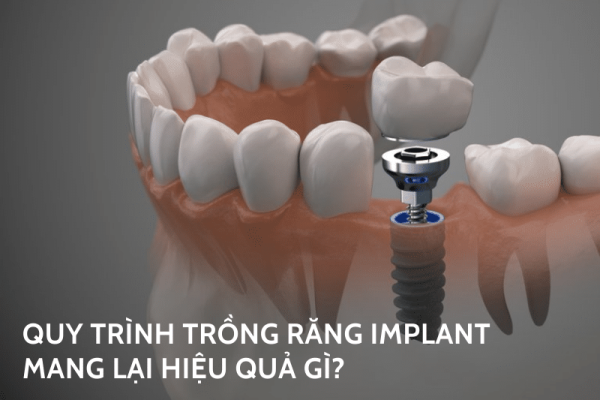 Quy trình trồng răng implant chuẩn y khoa