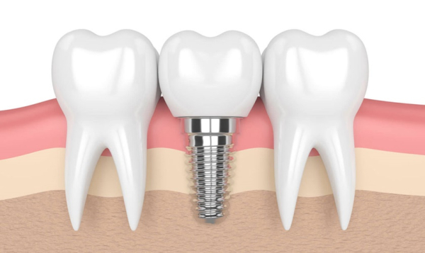 Trồng răng implant giá bao nhiêu một cái? Bảng giá mới nhất
