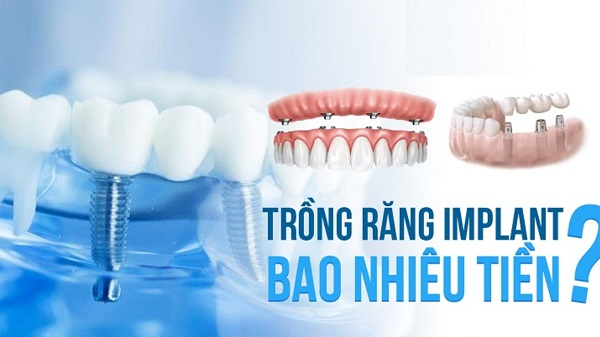 Tùy thuộc vào điều kiện cụ thể của răng miệng mà mức giá có thể dao động