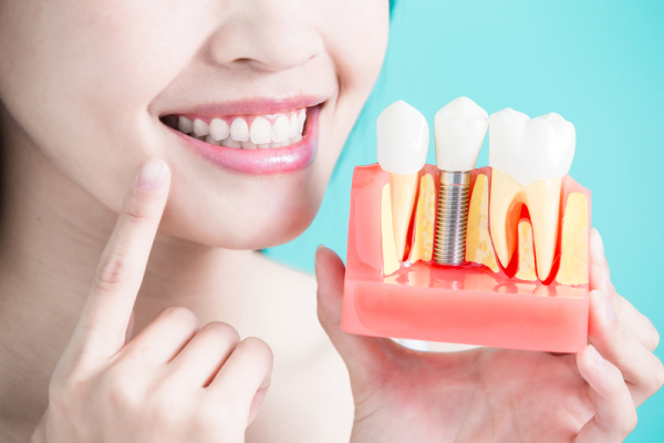 Có thể rút ngắn thời gian trồng răng Implant không?