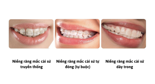 Phân loại niềng răng cài sứ phổ biến hiện nay
