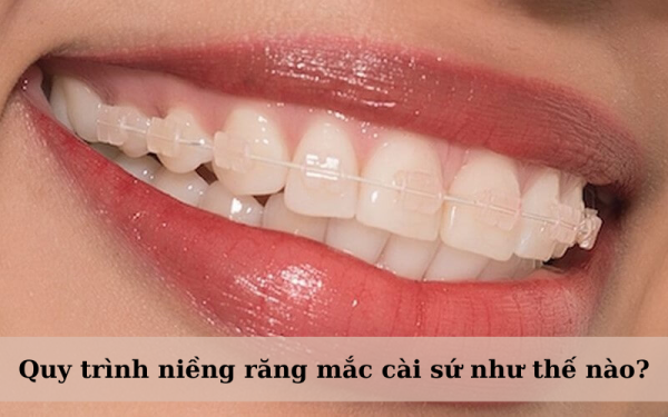 Quy trình niềng răng cài sứ an toàn, hiệu quả nhất tại Nha khoa MedicVN