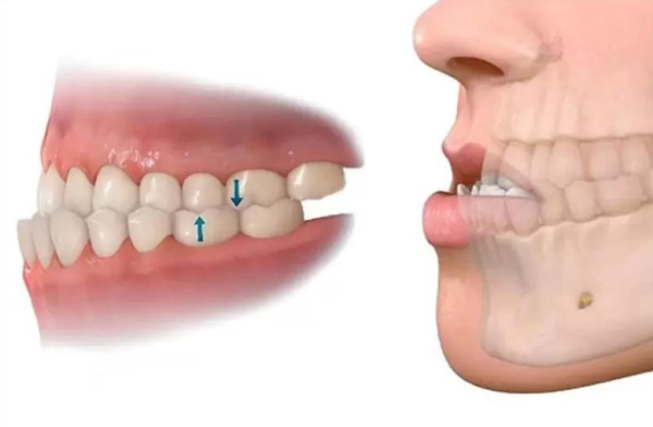 Niềng răng hô và các phương pháp điều trị hiệu quả hiện nay
