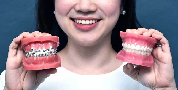 Niềng răng rẻ nhất bao nhiêu? Chi phí niềng răng mới nhất