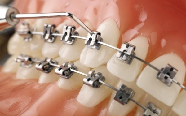 Những yếu tố ảnh hưởng đến chi phí của việc niềng răng