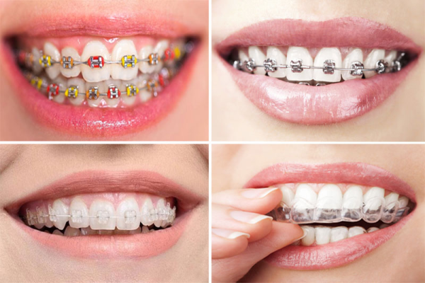 Khám phá các loại niềng răng phổ biến hiện nay