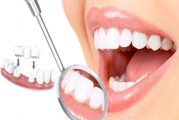 Bọc răng sứ bị ê buốt: Nguyên nhân và giải pháp hiệu quả