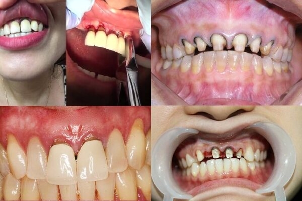 Bọc răng sứ có bền không? Yếu tố ảnh hưởng đến độ bền của răng sứ