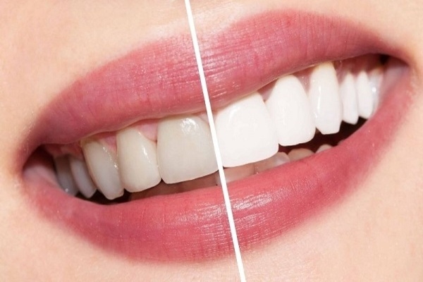Bọc răng sứ mang lại lợi ích gì?