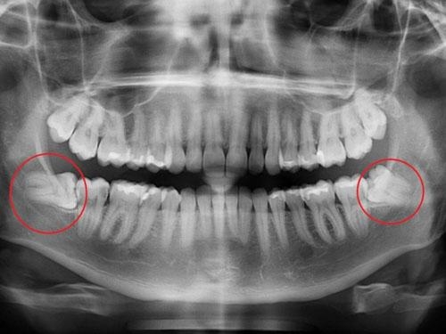 Sử dụng tia X để phát hiện mọi vấn đề tiềm ẩn của răng