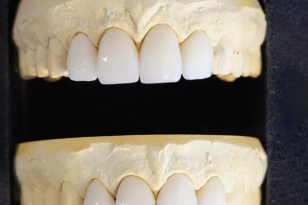 Bọc răng sứ cho 4 răng cửa bị hô được không?