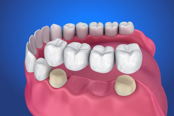 Cầu răng sứ là gì? Làm cầu răng sứ có tốt hay không?