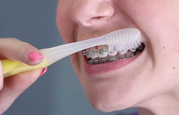Cách chăm sóc răng miệng sau khi niềng mắc cài sứ