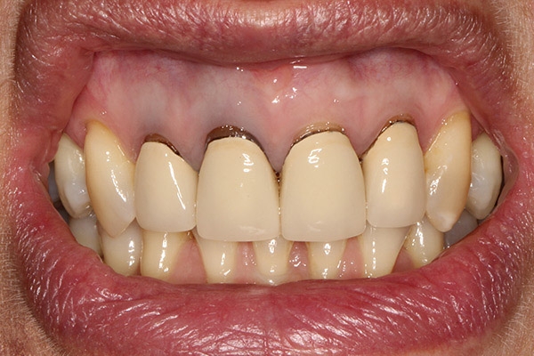 Răng sứ bị lung lay phải làm sao? Cách khắc phục hiệu quả