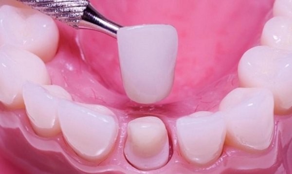 Răng sứ bị rớt ra: Nguyên nhân và cách khắc phục